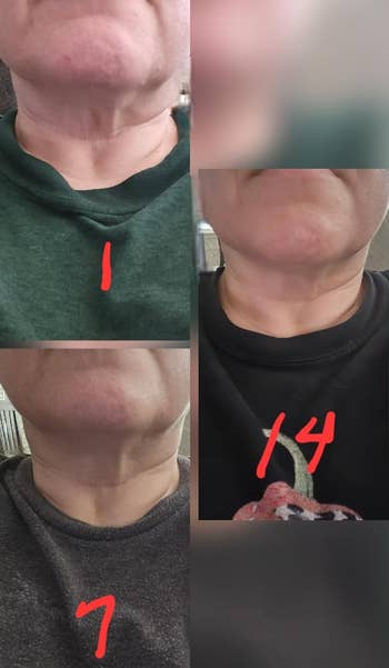 Collage showing progression of a person's cervix astatine antithetic stages, labeled 1, 7, and 14, indicating a two-week timeline