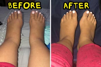 Before and aft  examination  of swollen and mean   feet, highlighting the effectiveness of a swelling simplification  product