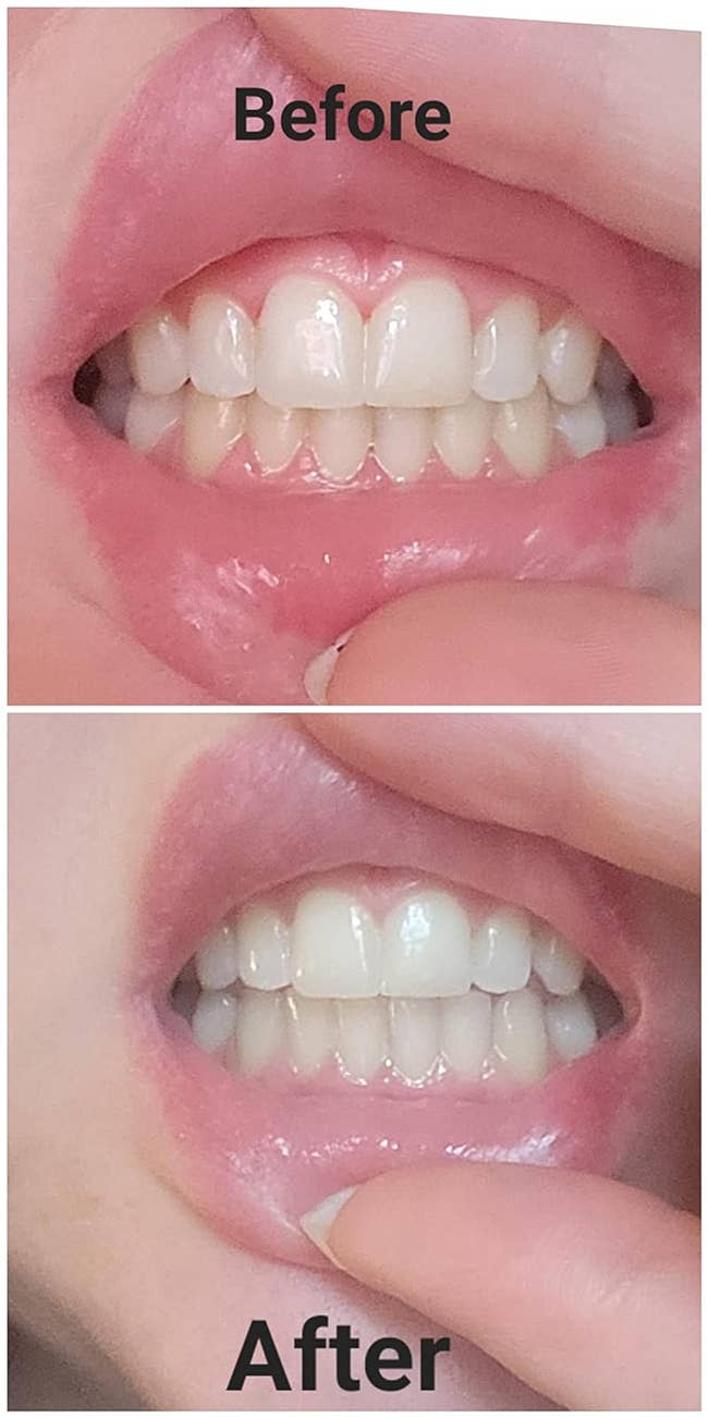 reviewer before and after using the pen for a month showing their teeth are noticeably brighter