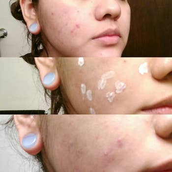 reviewer photos of their skin before, during, and after the use of the drying lotion