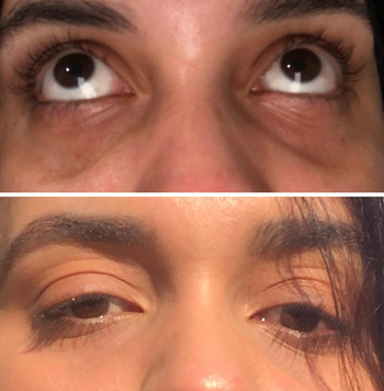 reviewer under eyes before and after using hydrating stick with dark circles much lighter after