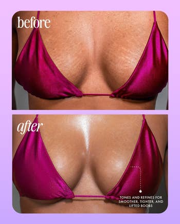 企業網站 before and after comparison of boobs with reduced stretchmarks