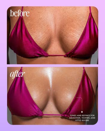 before and after comparison of boobs with reduced stretchmarks