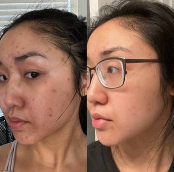 reviewers skin before and three weeks after using essence; dark spots faded after
