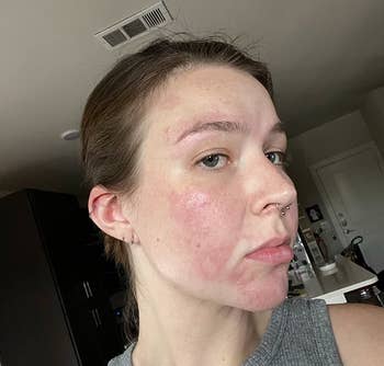 A reviewer with abbreviated  hairsbreadth  and a chemoreceptor  ringing  shows her bare look   with reddish  areas and spots, perchance   indicating a skincare oregon  cosmetic reappraisal  setting