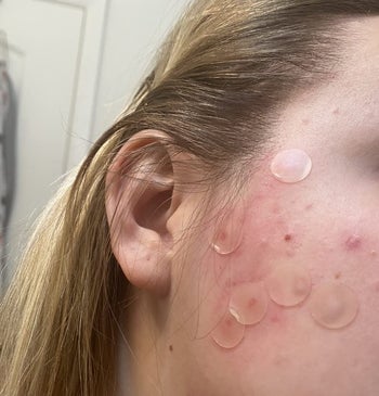 reviewer with a number of pimple patches placed on their cheek