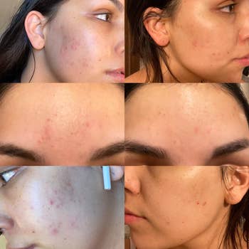 Three before and after photos that show a reviewer's blemishes slowly disappearing after using the toner