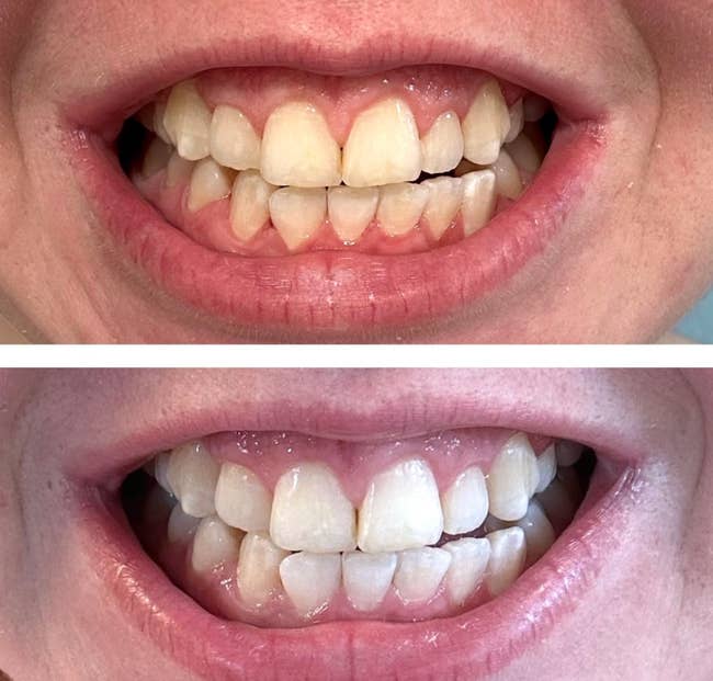before and after of reviewer's yellow and then whiter teeth