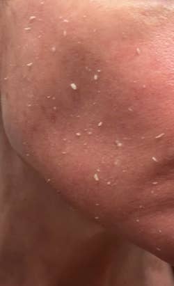 Close-up of skin with visible dryness and flaky patches, indicating a need for moisturizing skincare products