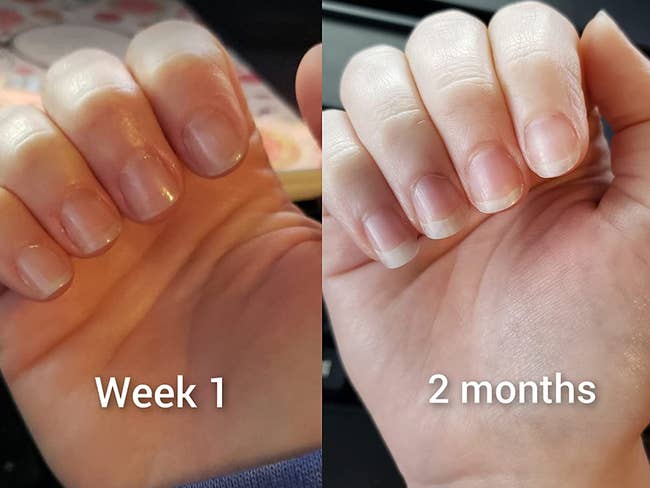 on the left, a reviewer's short nails one week after using the cream and on the right the same nails now looking longer and healthier two months after using the cream