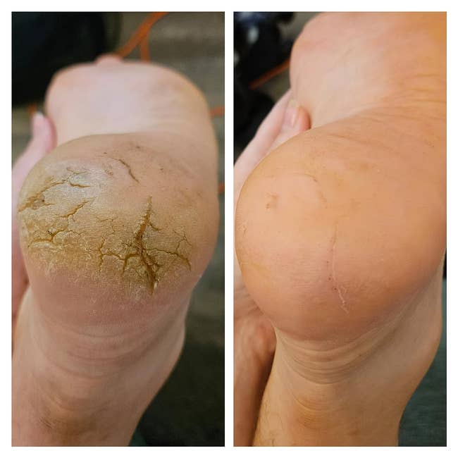 reviewer's cracked and gross looking heel, then same heal looking much more normal