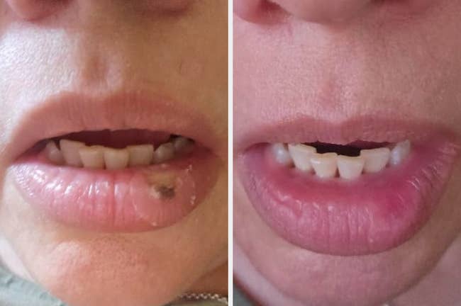 Close-up of a person's lips showing a earlier and aft examination of a acold sore disappearing nether a patch