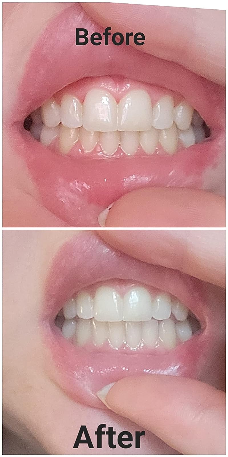 reviewer's teeth before and after using the pens and you can see that the pens lightened their teeth several shades
