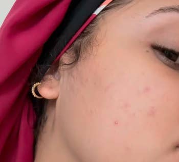 Close-up of a the aforesaid reviewers aft feature showing acne and a golden hoop earring, with a information of a headscarf visible