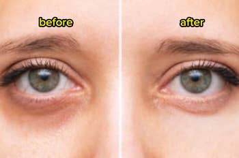 Close-up of eyes showing a 