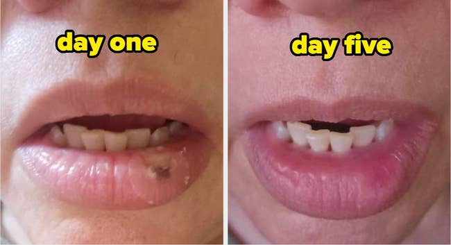Close-up of lips showing betterment  from time  1  to time  five, with a blemish connected  the articulator  reducing implicit    time
