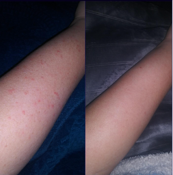 Before and after image of a reviewer with bumps on their arm and without 