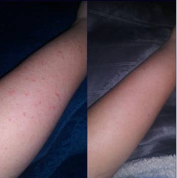 Before and after of a reviewer with bumps on their arm and without 