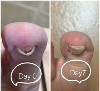 reviewer photo of their overly curved toenail next to a photo of the same toenail looking much straighter after one week