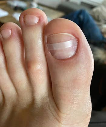Close-up of a ft with a the brace connected the toenail