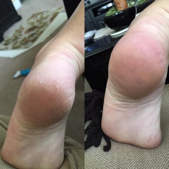 Reviewer showing before-and-after results of using Amore Pedi Perfect tool