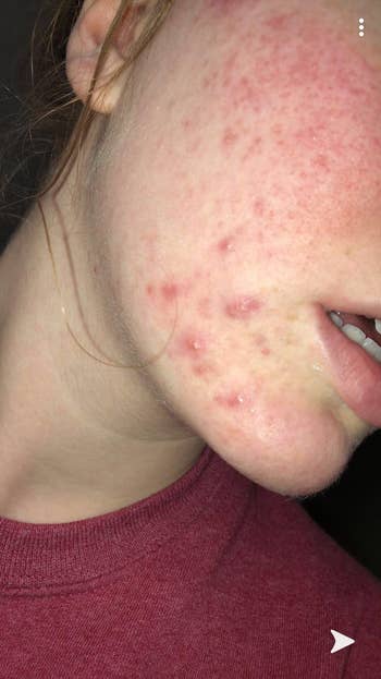 A reviewer with redness and acne connected  their skin