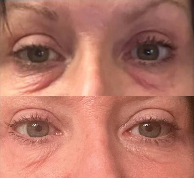 Close-up before and after images of a person's eyes, related to an under-eye treatment