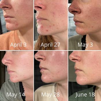top left to bottom right: reviewer's face with acne spots on April 3 and same face with less acne spots on June 18