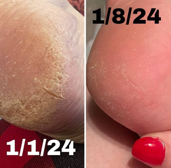 Before and after comparison of heel treatment, showing improved skin texture