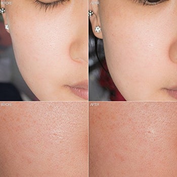 Before and after image of a model with evened out skin after using the scrub 