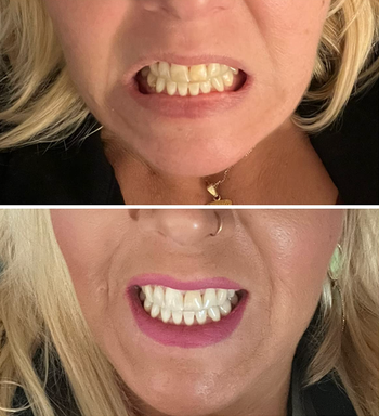 Reviewer with before picture of yellow teeth and after with them whitened 
