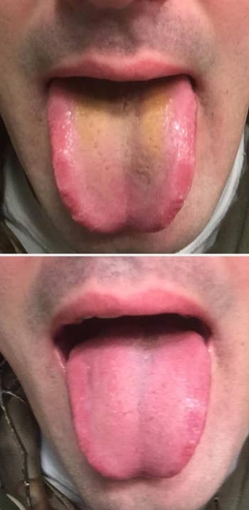 Two images amusement a person's tongue. The apical lingua has discoloration, portion the bottommost lingua appears normal