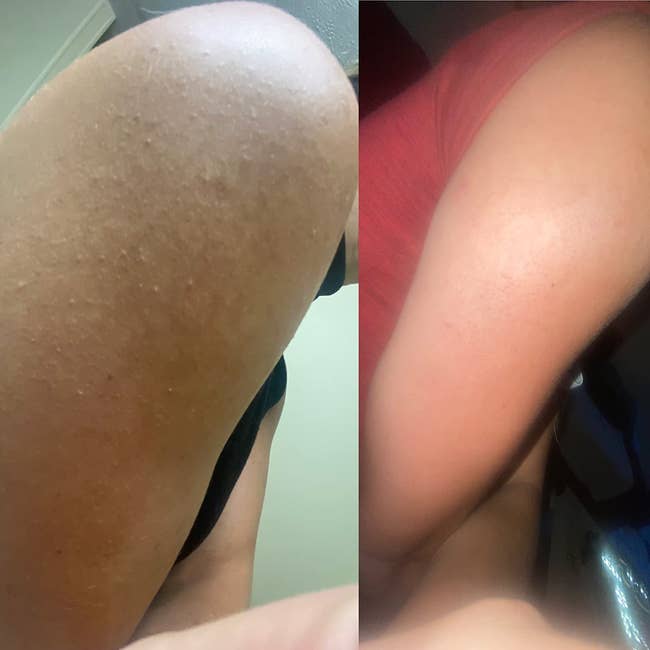 A reviewer's before and after results of their arm showing smoother skin after