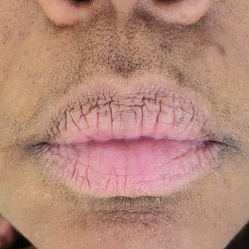 before photo of dark black hairs growing on a reviewer's upper lip and chin