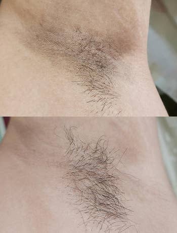 a reviewer's before with dark spots of their armpits and after of their arm pits with minimal spots after using kojic acid soap