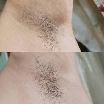 a reviewer's before with dark spots of their armpits and after of their arm pits with minimal spots after using kojic acid soap 