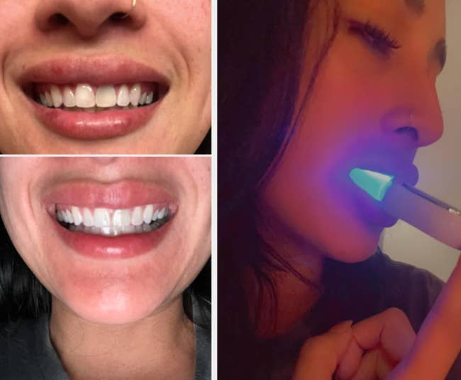 Close-up of a person showing their teeth in two images. In the third, they use a blue-light teeth whitening device