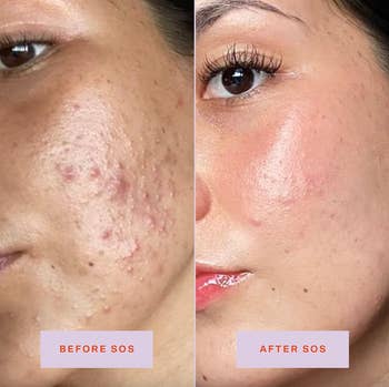 person before using the spray with a lot of acne and after with clearer skin