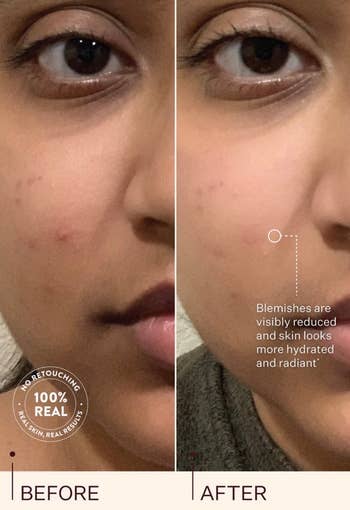 Close-up comparison of a person's face before and after using a skincare product, showing reduced blemishes and smoother skin