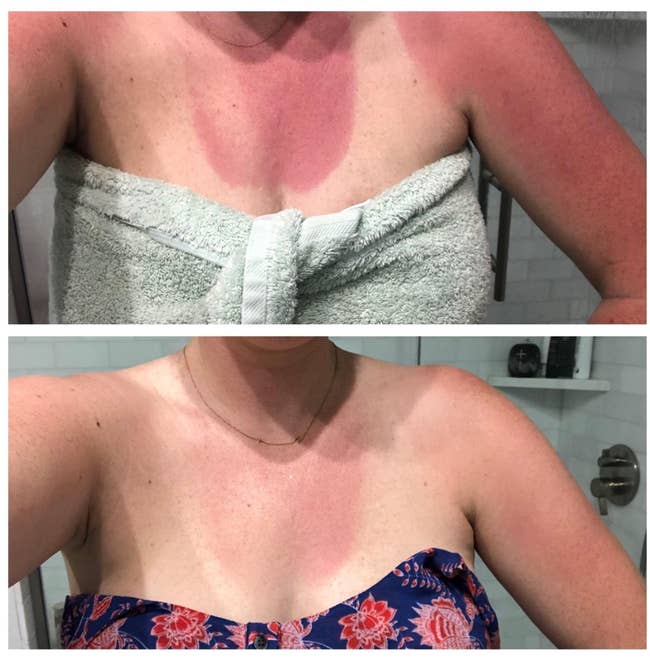 reviewer image of chest before using lotion where it's sunburned, and after applying it four times over 24 hours and the burn has diminished significantly