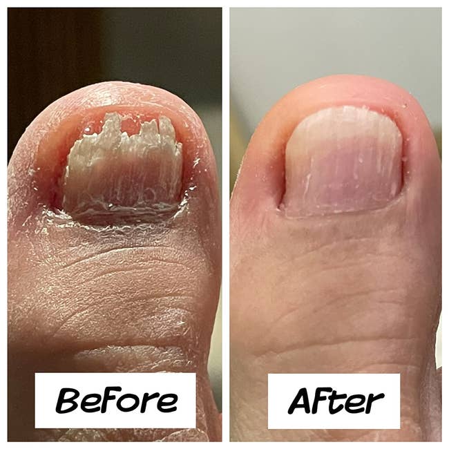 Before and aft images of a toenail, showing betterment from cracked and damaged to creaseless and healthy