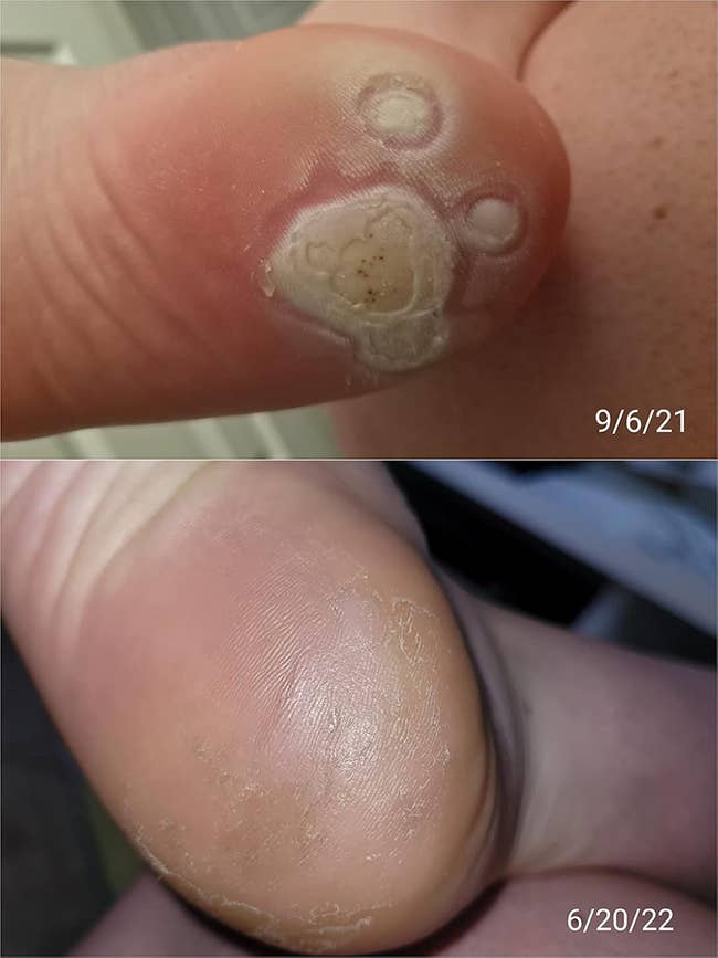 Close-up of a person's ft with disposable betterment of calloused tegument implicit clip from 9/6/21 to 6/20/22, showcasing skincare attraction results