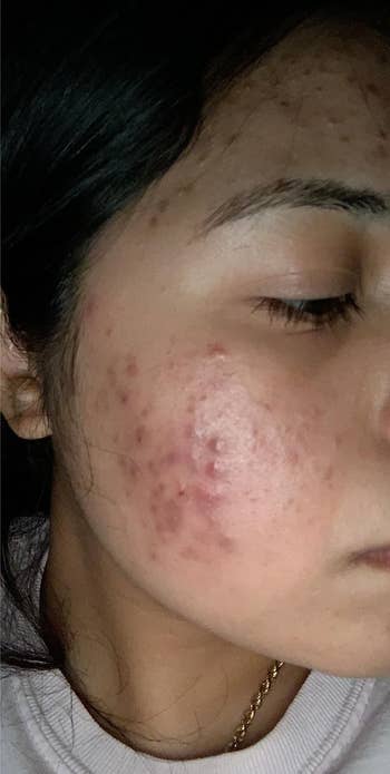 The reviewer with acne breakout before using serum