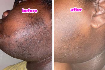 the reviewer earlier  and aft  utilizing the toner pads to cleanable  up   ingrown hairsbreadth  bumps