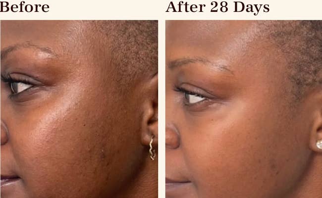A model with visible hyperpigmentation/The same model with less visible hyperpigmentation