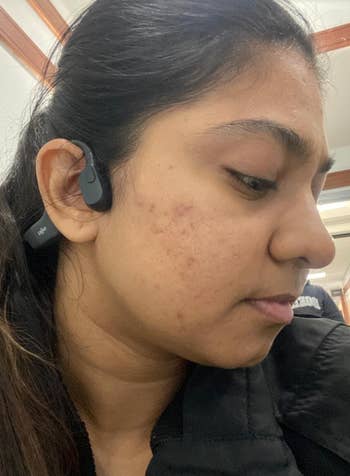 same reviewer's skin, noticeably clearer after using post-blemish balm