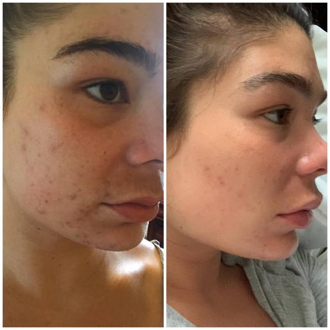 A reviewer's before and after showing reduced acne and scarring on their face