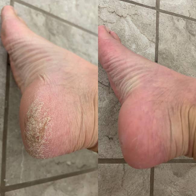 reviewer's bottom of foot with calluses, then after without the calluses