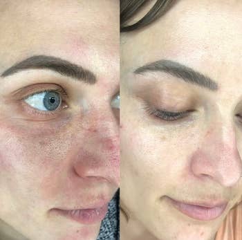 before and after images of a reviewer with inflamed red skin that then looks clear, even, and calm