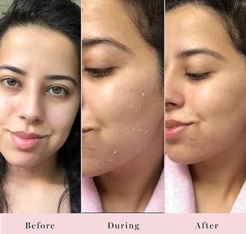 Three-part facial skincare results showing a woman before, during treatment with product, and after with improved skin